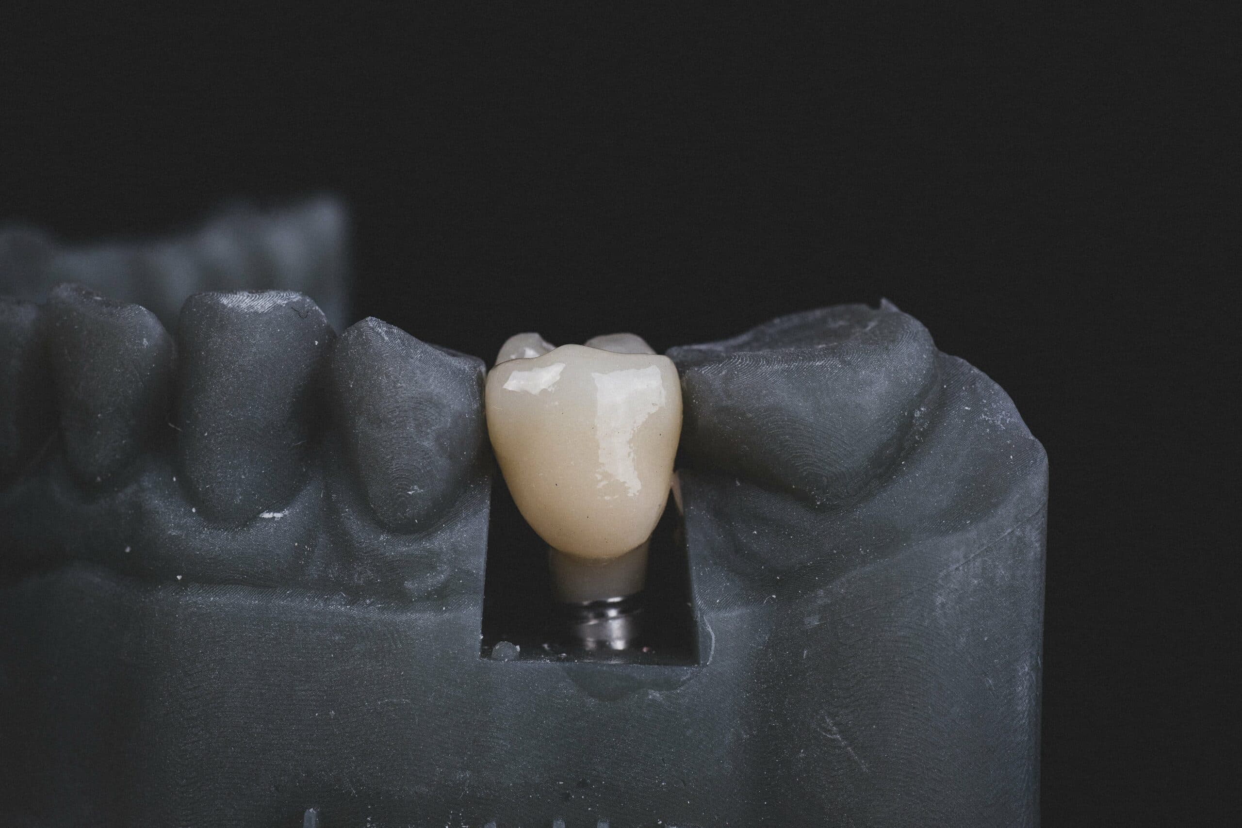 Full mouth rehabilitation planning at The Dentist in Dubai