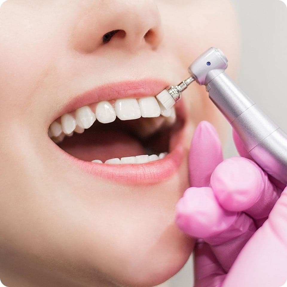 Composite veneer sculpting at The Dentist in Dubai